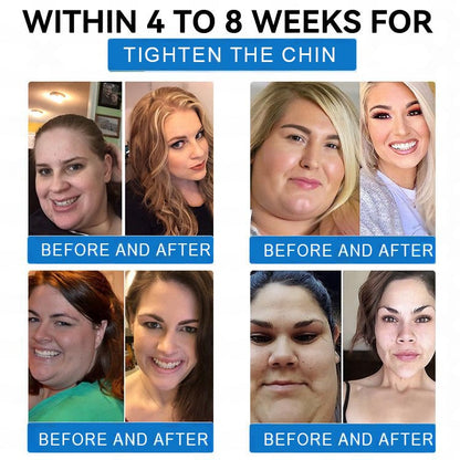 【Last Day Promotion 80% OFF🌟】🎃🎃Grunsify® SMGT-GLP-1 𝐓𝐢𝐫𝐳𝐞𝐩𝐚𝐭𝐢𝐝𝐞 & 𝐂𝐨𝐥𝐥𝐚𝐠𝐞𝐧 𝐍𝐚𝐧𝐨 𝐌𝐢𝐜𝐫𝐨𝐧𝐞𝐞𝐝𝐥𝐞 𝐖𝐞𝐢𝐠𝐡𝐭 𝐋𝐨𝐬𝐬 𝐏𝐚𝐭𝐜𝐡丨Targets Obesity, Loose Skin, High Blood Pressure, Diabetes, Fatty Liver, Joint Pain, Brain Fog, Low Energy, Body Aches, and More